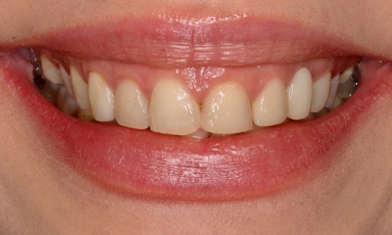 Before